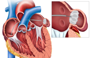Anatomical illustration of the heart with sagittal view and the closure of the left atrial appendix with a Watchman device.