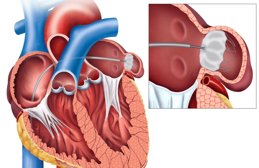 Anatomical illustration of the heart with sagittal view and the closure of the left atrial appendix with a Watchman device.