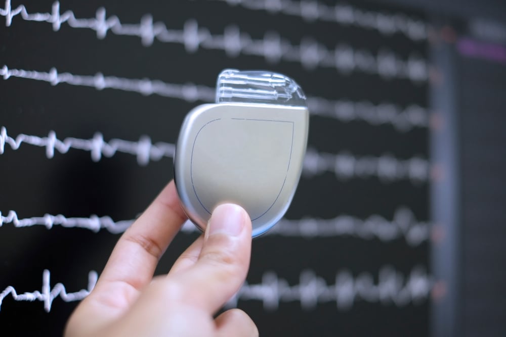 Implantable Cardioverter Defibrillator (ICD) Device for Heart Arrhythmia
