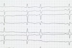 Brudaga Syndrome Treatment in Phoenix Arizona