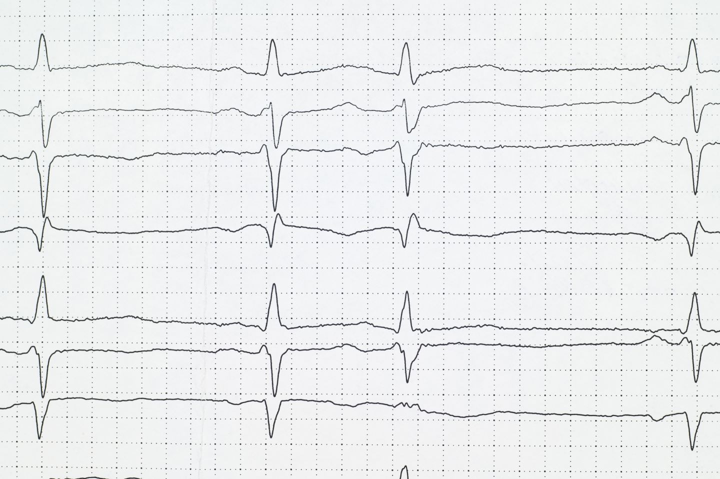 Understanding Brugada Syndrome and Why Early Detection Matters - The ...